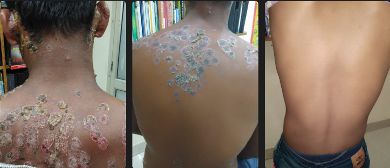 Back Psoriasis — Clear Skin Achieved
