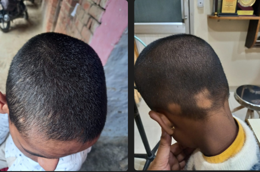 Alopecia Areata — Another Recovery
