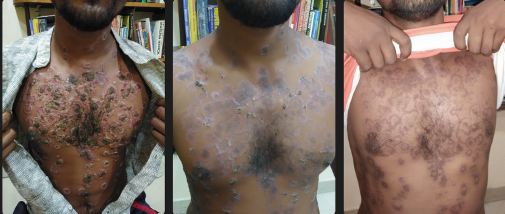 Severe Chest Psoriasis — Healing in Progress