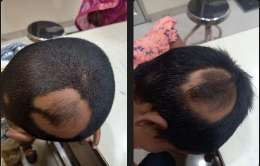 Alopecia Areata — Visible Regrowth